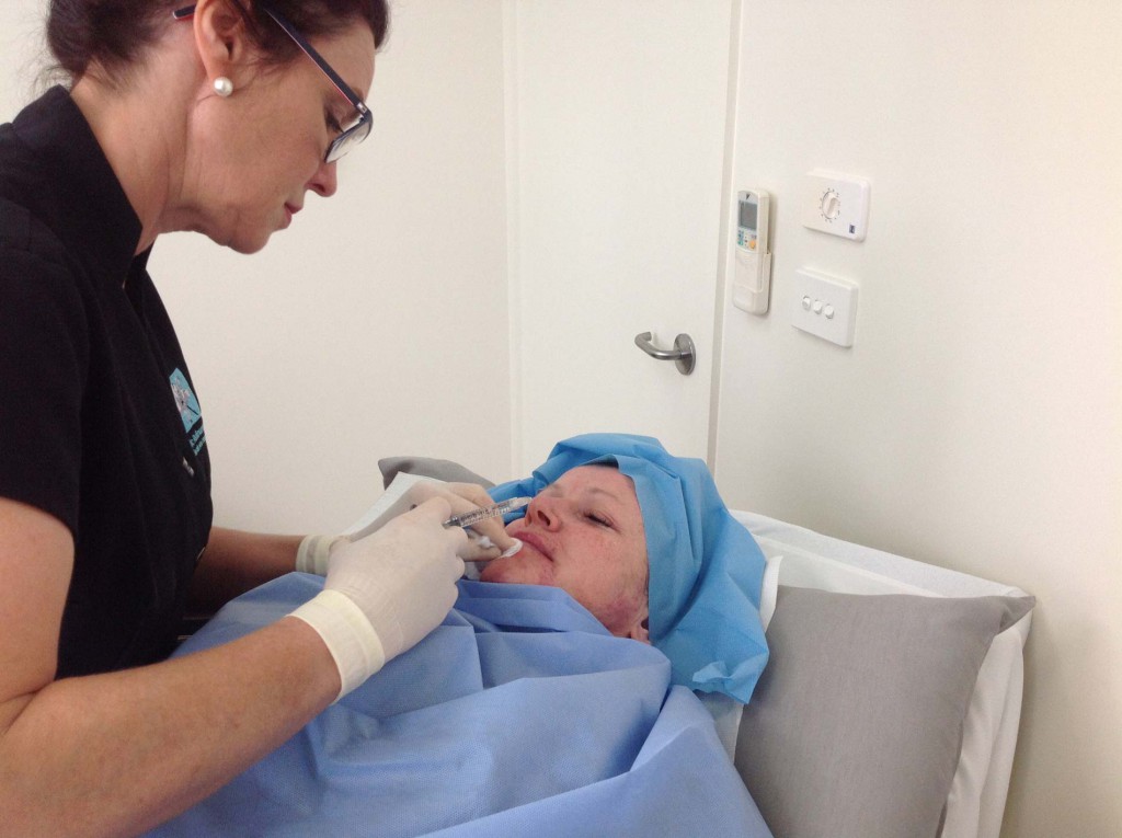 Ms Niamh Corduff performing a cosmetic injections treatment to a patient's lips | Cosmetic Injectables | Cosmetic Refinement Clinic Geelong