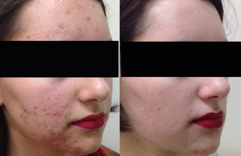 A before and after photo of an acne treatment patient | Acne Treatment Geelong