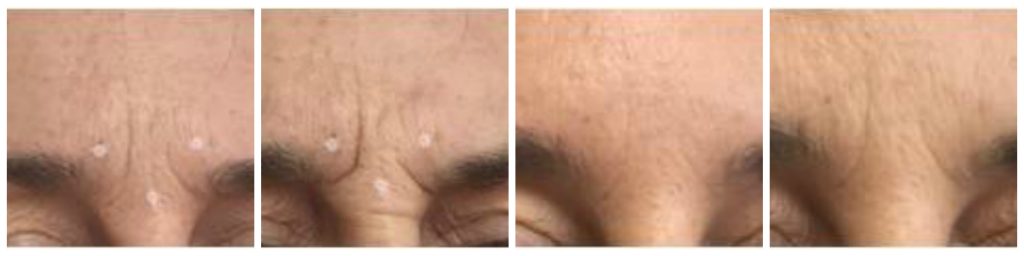 anti wrinkle injections | before and after pictures of a patient who has received anti-wrinkle injections treatment