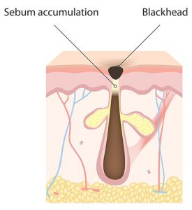 A diagram of blackhead acne