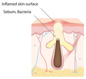 A diagram of papule acne